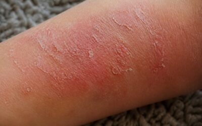 Dermatita atopică și mâncărimea nocturnă: cauze și sfaturi de îngrijire