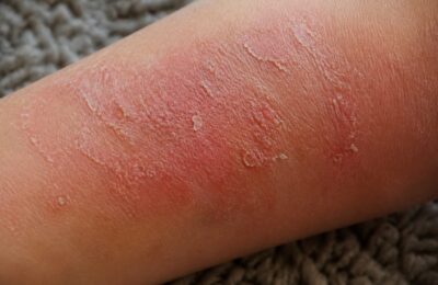 Dermatita atopică și mâncărimea nocturnă: cauze și sfaturi de îngrijire
