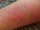Dermatita atopică și mâncărimea nocturnă: cauze și sfaturi de îngrijire
