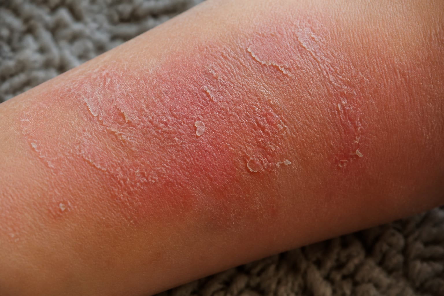 Dermatita atopică și mâncărimea nocturnă: cauze și sfaturi de îngrijire