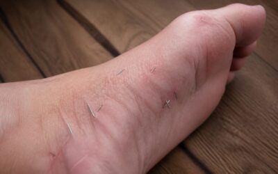 Peste zece ace de acupunctură rupte, găsite în piciorul unei paciente din Rusia