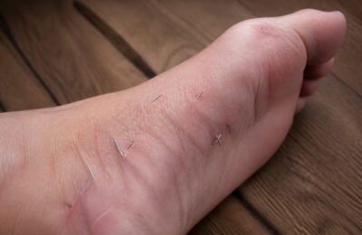 Peste zece ace de acupunctură rupte, găsite în piciorul unei paciente din Rusia