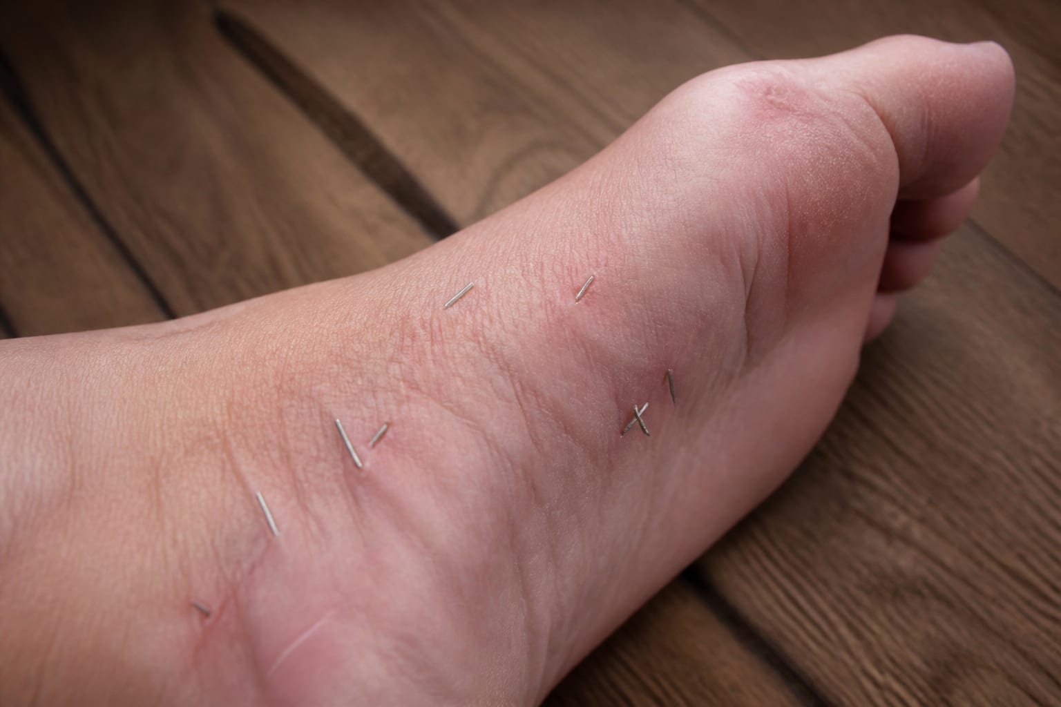 Peste zece ace de acupunctură rupte, găsite în piciorul unei paciente din Rusia