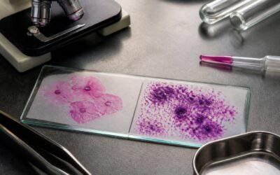 Vaginoza bacteriană poate tripla riscul de infecții cu transmitere sexuală