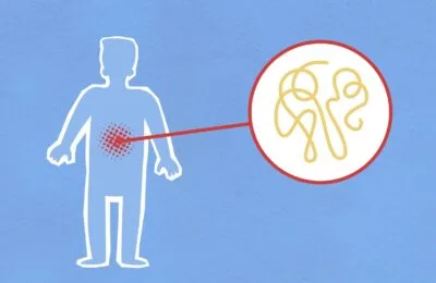 Sângele în urină și febra cu dureri de spate cer ajutor medical rapid. Suplimentele nu înlocuiesc tratamentul